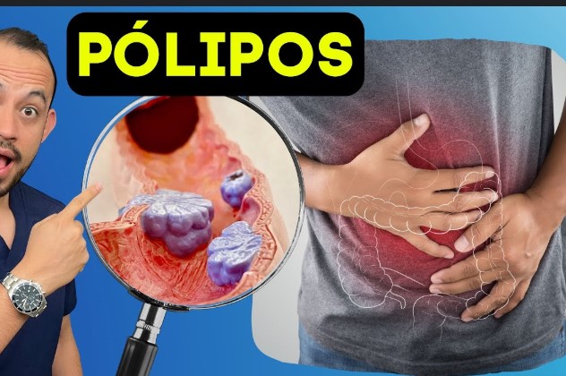 Cómo Disolver Pólipos en los Intestinos de Forma Natural